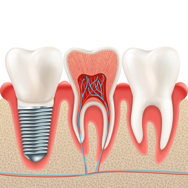 Vector juego de implantes dentales.