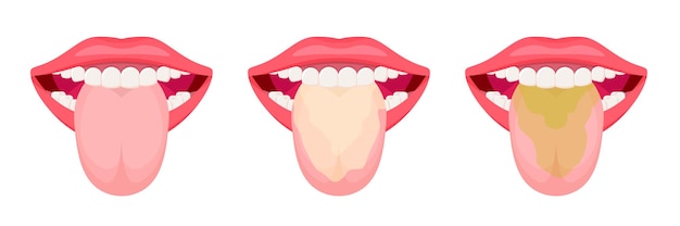 Lengua con una capa blanca y limpia. Concepto de higiene bucal aislado sobre fondo blanco.