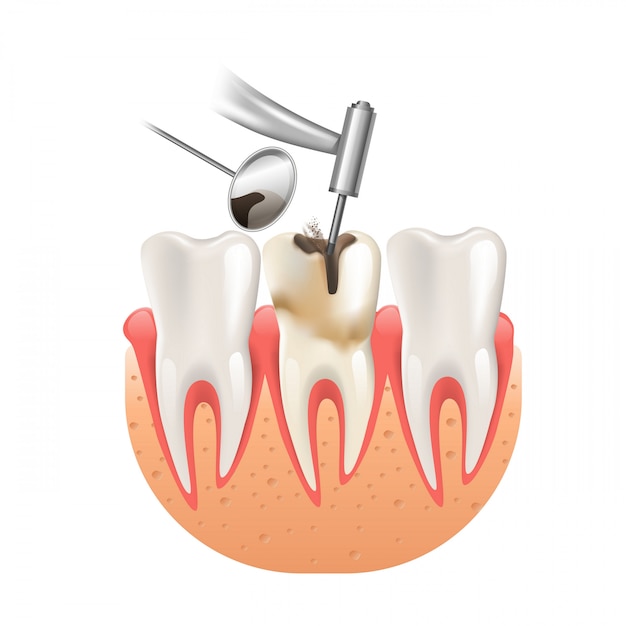 Vector limpieza de caries por taladro dental dental