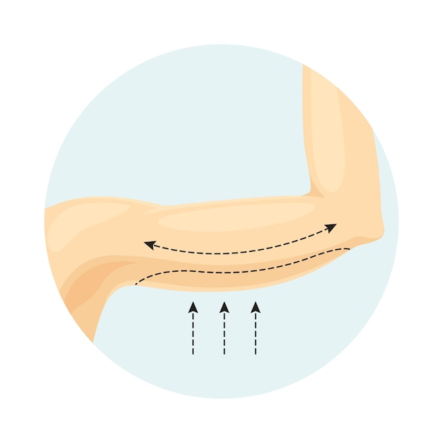 Liposucción de los brazos Ilustración vectorial de cirugía plástica o estética