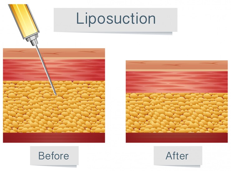 Vector liposucción tratamiento médico y comparación
