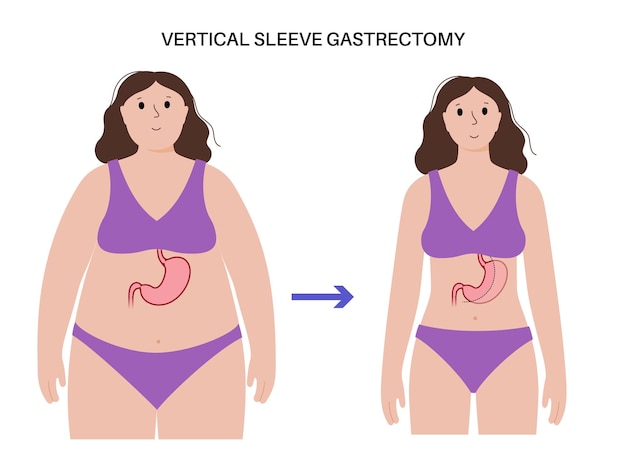Vector manga vertical gastrectomía laparoscopia cirugía de estómago pérdida de peso procedimiento gástrico