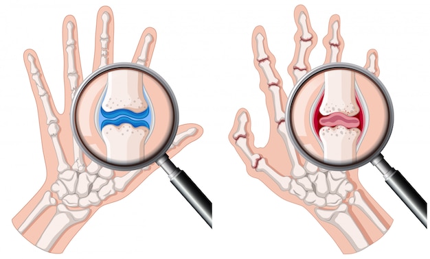 Una mano humana con artritis reumatoide