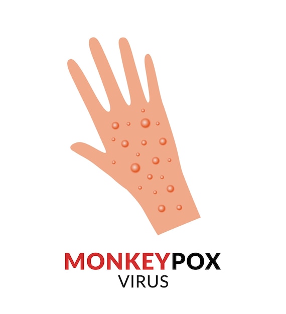 mano, con, monkeypox, erupción, vector, ilustración