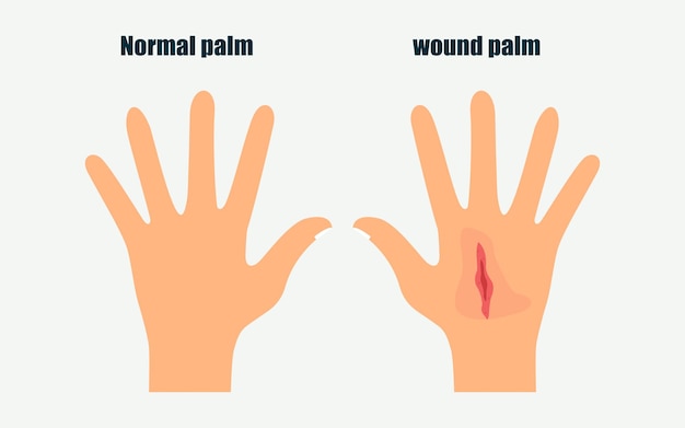 Vector una mano normal comparar con la ilustración de vector de mano de heridas