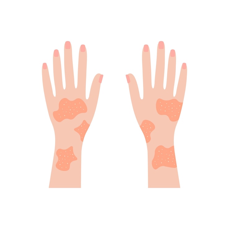Vector manos cubiertas de sarpullido erupciones psoriásicas rojas y eccema inflamado