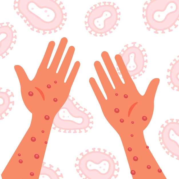 Manos humanas con virus de la viruela del mono en el fondo microscópico del vector del virus dibujado a mano plana i
