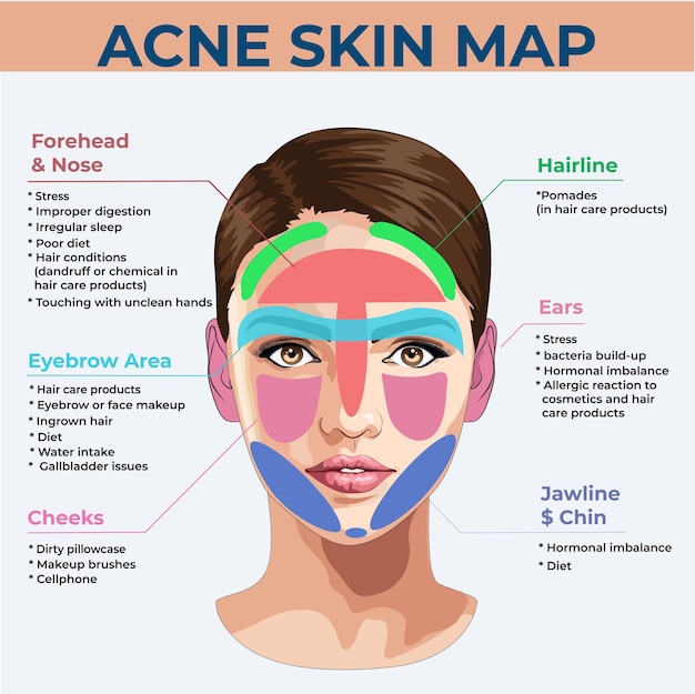 Vector mapa de la piel del acné