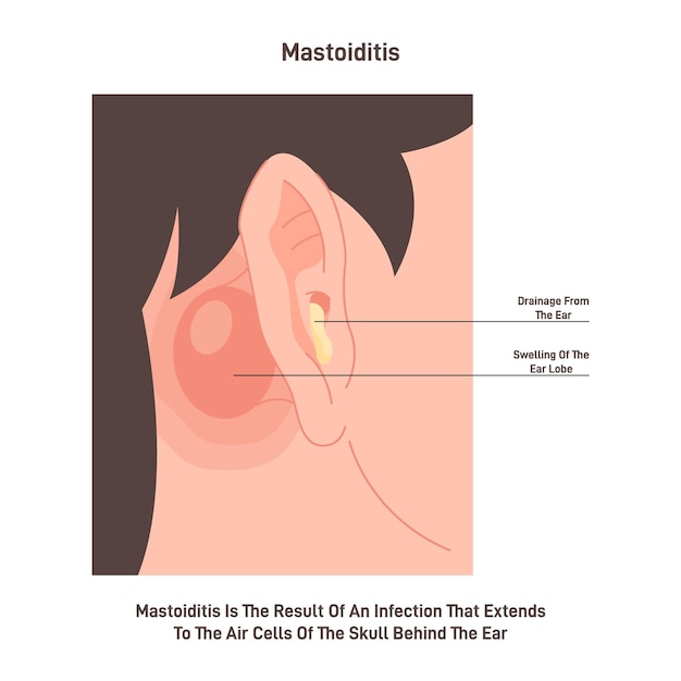 Vector mastoiditis enfermedad inflamatoria del oído mastoides bacterianos