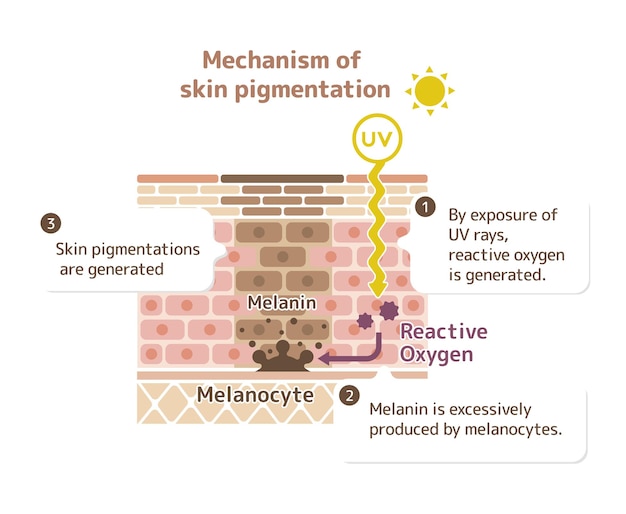 Vector mecanismo de pigmentación de la piel ilustración de las manchas cutáneas