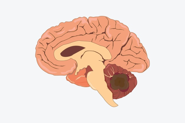 Meduloblastoma del cerebro humano sección transversal vista lateral eps 10