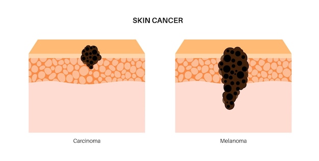 Vector melanoma y carcinoma