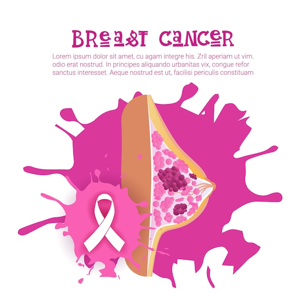 Mes de la concientización sobre el cáncer de mama