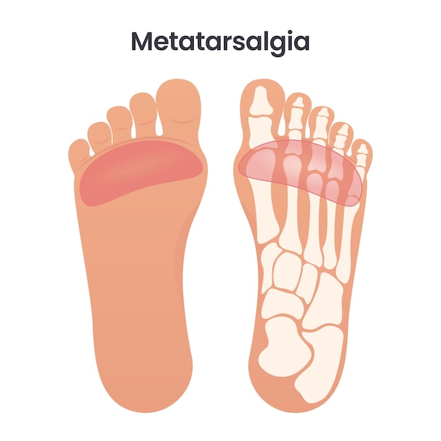Metatarsalgia dolor en la bola del pie gráfico de ilustración de vector educativo médico