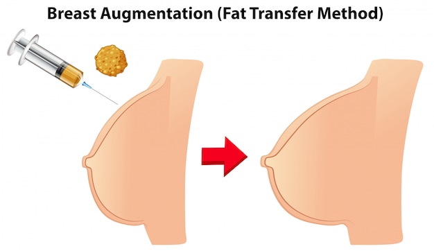Vector método de transferencia de grasa de aumento mamario