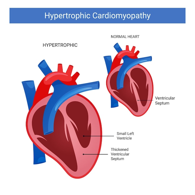 Vector miocardiopatía hipertrófica diferencia corazón normal e hipertrófico.