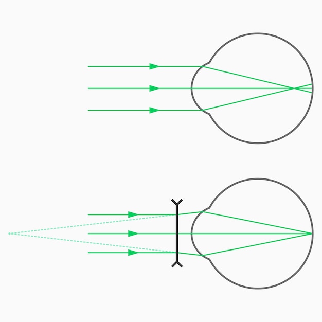 Miopía (visión corta) y corrección de la miopía con gafas