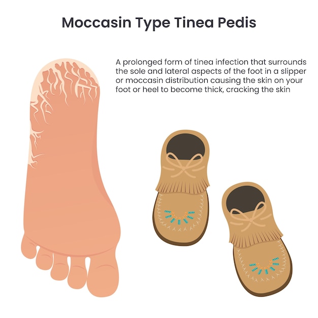 Mocasín tipo tinea pedis atleta educación alimentaria vector infografía