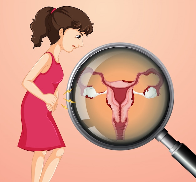 Vector mujer con cáncer de ovario