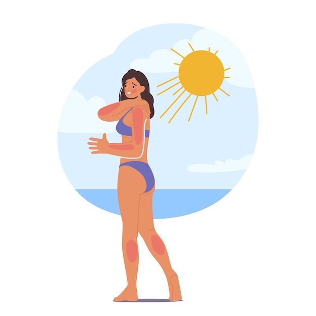 Mujer experimenta quemaduras de sol en la piel en la playa debido a la exposición excesiva al sol La piel del personaje femenino aparece roja e irritada