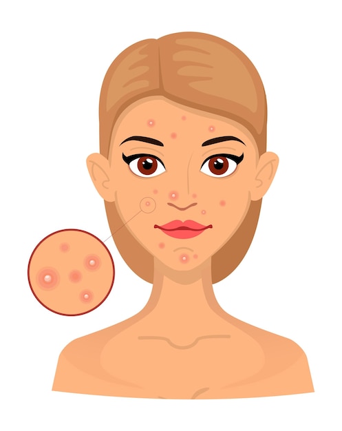 Vector para mujeres, tipos de piel con acné, piel con problemas, área agrandada para cosmetología. acné, arrugas y manchas de la edad. cuidando la piel. vector