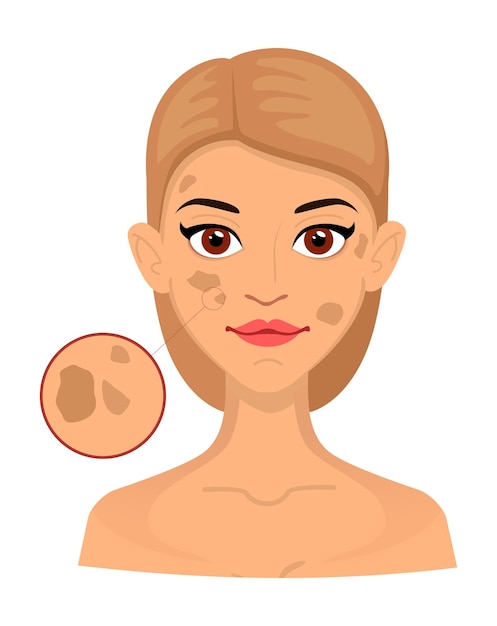 Para las mujeres, tipos de piel con manchas de la edad, vetiligo, un área agrandada para cosmetología. Acné, arrugas y manchas de la edad. Cuidando la piel. vector