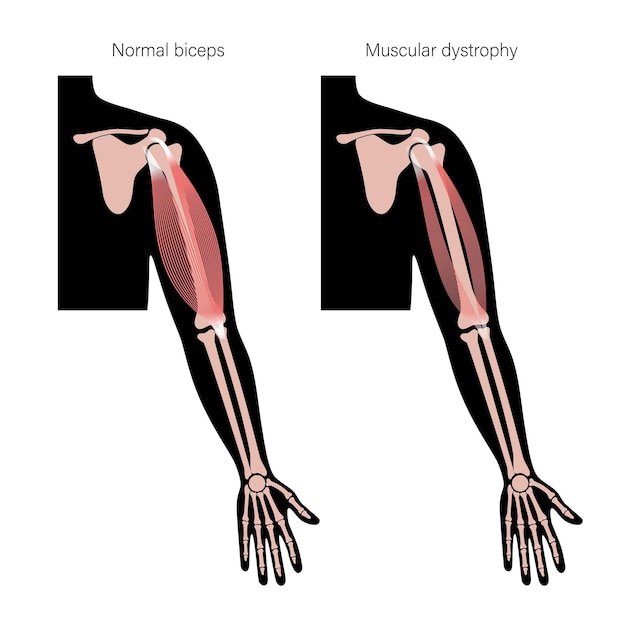 Músculos del brazo humano