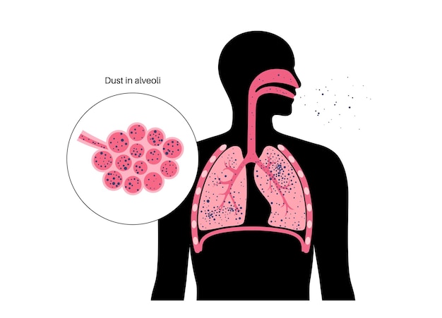 Vector neumoconiosis enfermedad pulmonar