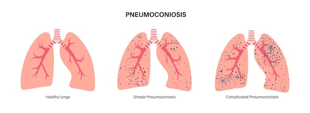 Vector neumoconiosis enfermedad pulmonar