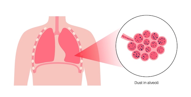 Vector neumoconiosis enfermedad pulmonar