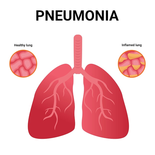 Vector neumonía alvéolos normales e infectados icono plano de dibujos animados de pulmones sanos y enfermos