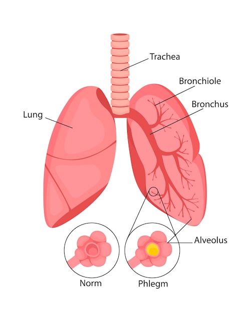 Neumonía Estado normal e inflamatorio de los pulmones e inflamación de los alvéolos con líquido.