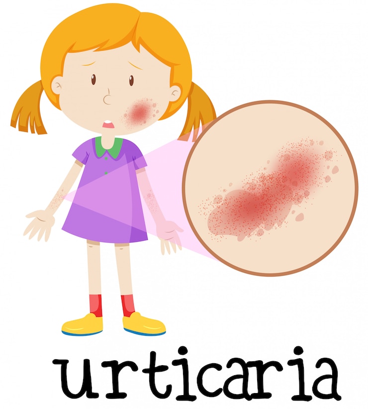 Vector una niña con urticaria en la piel