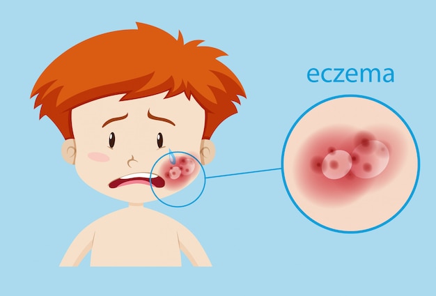 Niño enfermo con eczema