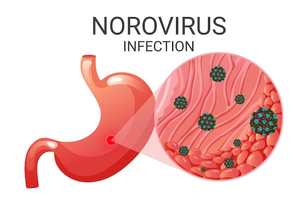 Norovirus en células epiteliales del estómago bajo ampliación