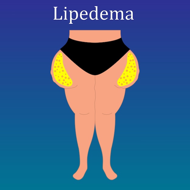 Obesidad lipedema vector ilustración. cirugía liposucción educación, publicidad