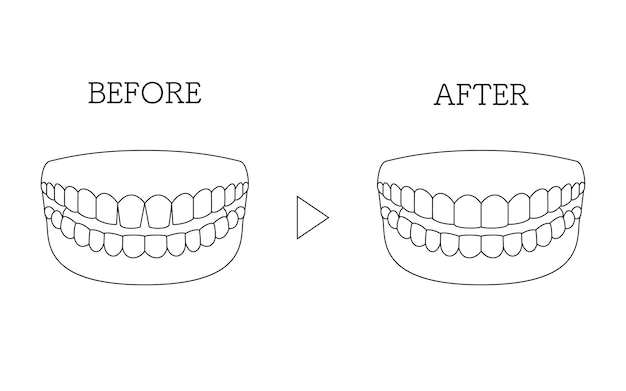 Vector odontología cosmética unión directa antes y después de los dientes anteriores con huecos