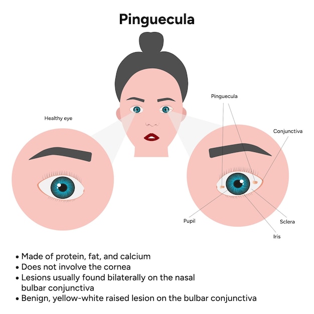 Oftalmología Información e infografía sobre la pinguecula