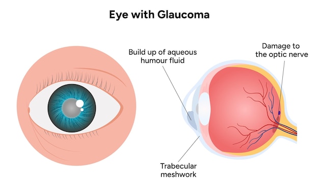 Ojo con enfermedad de glaucoma infografía médica con anatomía óptica del ojo humano