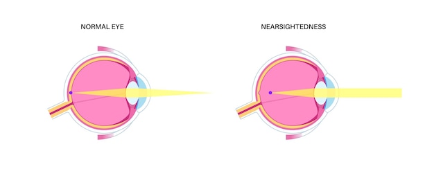 Vector ojo normal y miopía