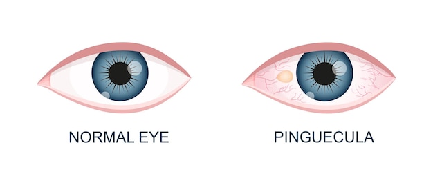 Vector ojo sano y con pinguécula degeneración conjuntival antes y después de la cirugía