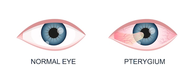 Ojo sano y con pterigión degeneración conjuntival antes y después de la cirugía enfermedad ocular