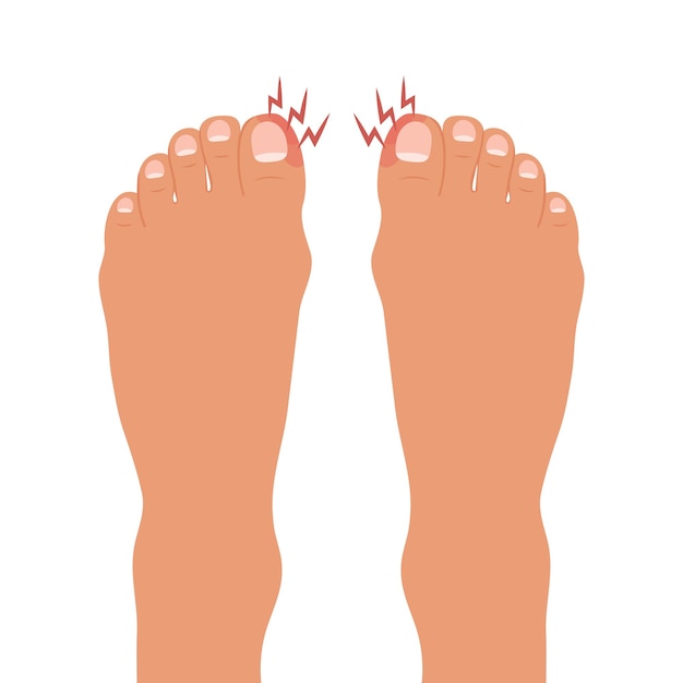 Vector onicocriptosis del dedo del pie hinchado pié con enfermedad o infección de las uñas pié con onicomicosis.