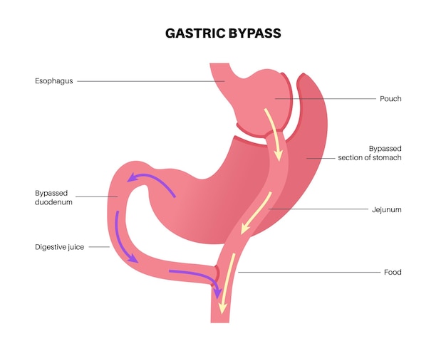 Operación de gastroplastia de bypass gástrico RYGB concepto de cirugía estomacal problema de obesidad procedimiento de pérdida de peso Afiche médico de laparoscopia abdominal Problema de sobrepeso en la ilustración vectorial del cuerpo humano
