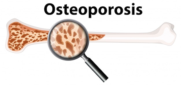 Osteoporosis y lupa