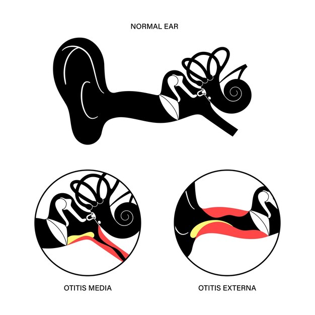 Vector otitis media externa