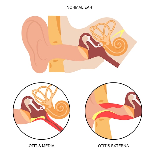 Vector otitis media externa