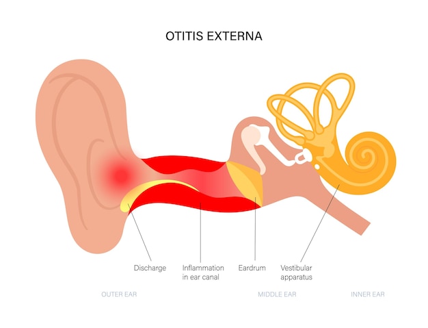 Otitis del oído del nadador