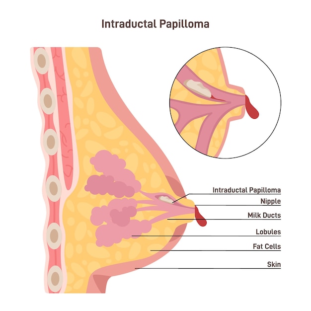 Vector papiloma intraductal virus del papiloma humano vph neoplasia en la mama