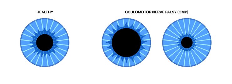 Vector parálisis del nervio oculomotor